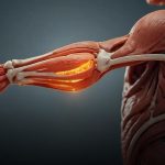 O que é neurite muscular? entenda sintomas e tratamentos atuais
